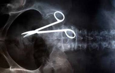 Scissors in Woman's Stomach: कॅन्सरच्या शस्त्रक्रियेदरम्यान महिलेच्या पोटात डॉक्टरांकडून राहिली कात्री; 2 वर्षानंतर सीटी स्कॅनमध्ये समोर आली धक्कादायक घटना