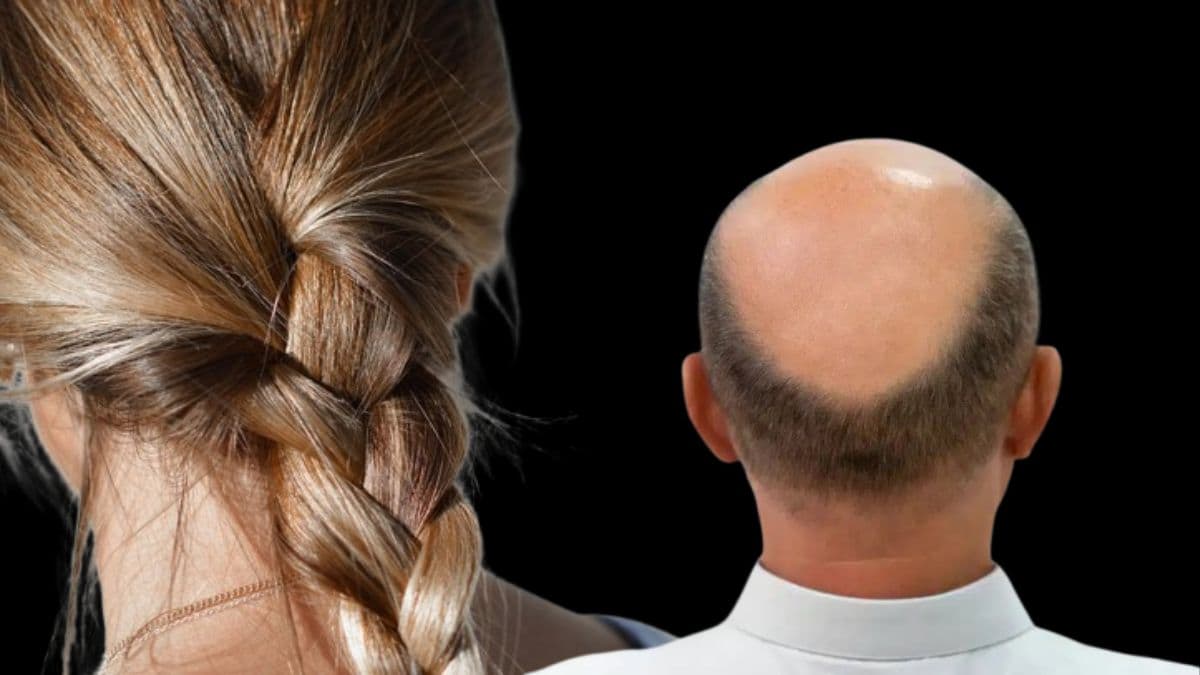 Hair Loss Causes: केस गळती संपेना, टक्कल पडणे थांबेना; ICMR म्हणे 'असला प्रकार कधीच पाहिला नाही'