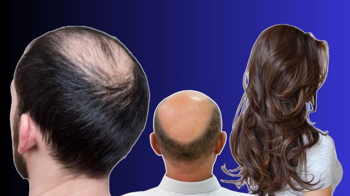 Premature Hair Loss Prevention: अकाली केस गळणे आणि टक्कल पडणे टाळण्यासाठी काय करावे?