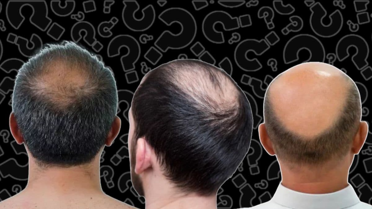 Why Do Men Go Bald? पुरुषांचे केस का गळतात? त्यांना टक्कल पडण्याची कारणे काय? तज्ज्ञांनी सांगितली कारणे