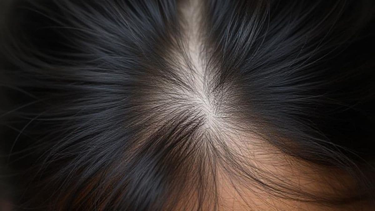 Itchy Scalp Causes and Relief: तुमच्या डोक्याच्या टाळूला खाज सुटते का? कारणे आणि उपाय घ्या जाणून