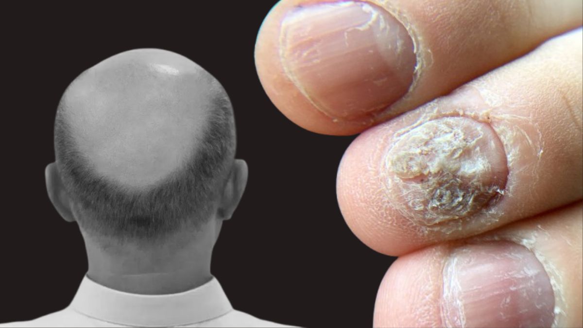 Nail Disorders Buldhana: केस आले पण नखं गेली, बुलढाणा जिल्ह्यातील नागरिकांमध्ये गळतीची विचित्र समस्या