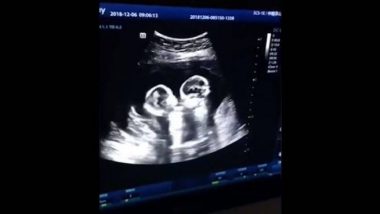 आईच्या पोटात जुळ्या अर्भकांची मस्ती; व्हिडिओ सोशल मीडियात व्हायरल (Watch Video)