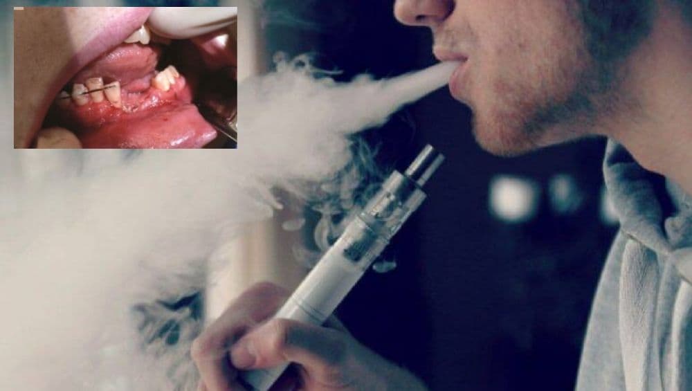धक्कादायक! E-Cigarette चा तोंडात स्फोट; अल्पवयीन मुलाचा जबडा फाटून दात बाहेर धक्कादायक! E-Cigarette चा तोंडात स्फोट; अल्पवयीन मुलाचा जबडा फाटून दात बाहेर