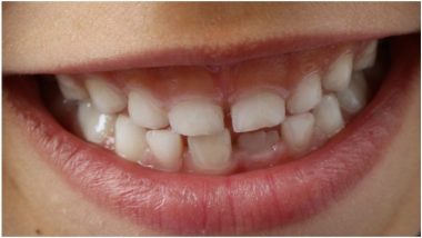 चेन्नई: 7 वर्षांच्या मुलाच्या तोंडातून डॉक्टरांनी काढले तब्बल 526 लहान-मोठे दात; पहा फोटोज