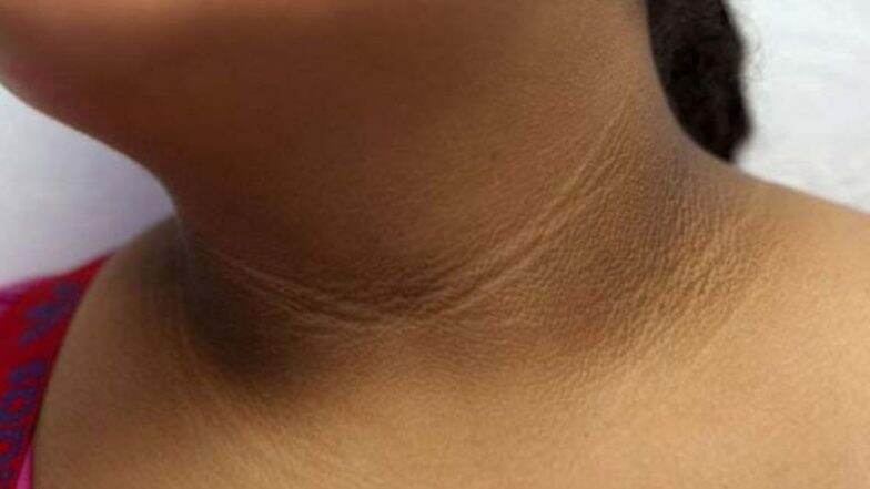गळ्यावर आलेले काळे डाग 'या' घरगुती उपायांनी करा दूर गळ्यावर आलेले काळे डाग 'या' घरगुती उपायांनी करा दूर