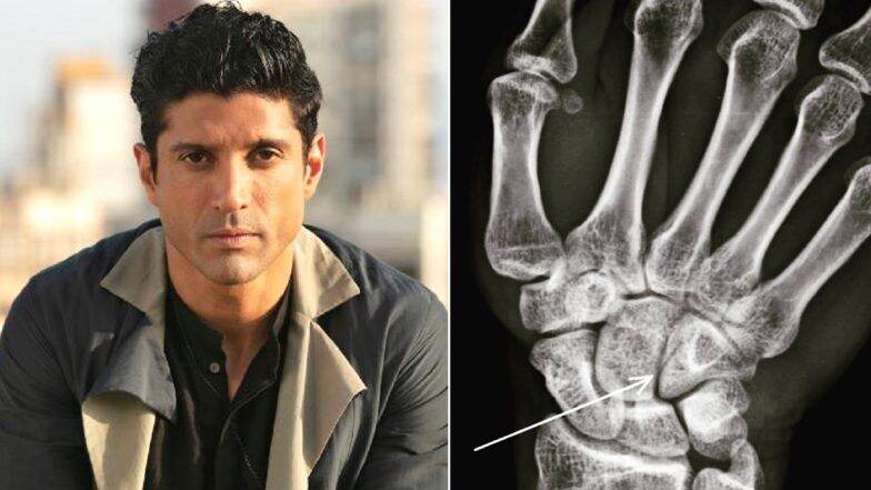Toofan च्या शूटिंग वेळी Farhan Akhtar च्या हाताला झाले फ्रॅक्चर; Instagram वर फोटो केला शेयर Toofan च्या शूटिंग वेळी Farhan Akhtar च्या हाताला झाले फ्रॅक्चर; Instagram वर फोटो केला शेयर