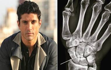 Toofan च्या शूटिंग वेळी Farhan Akhtar च्या हाताला झाले फ्रॅक्चर; Instagram वर फोटो केला शेयर