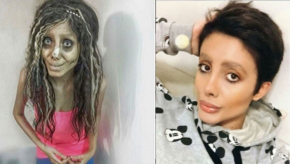 अँजेलीना जोली सारखे बनण्यासाठी केल्या अनेक शस्त्रक्रिया; चेहरा विद्रूप झाल्यावर सरकारने केली Insta-Star ला अटक (Photos) अँजेलीना जोली सारखे बनण्यासाठी केल्या अनेक शस्त्रक्रिया; चेहरा विद्रूप झाल्यावर सरकारने केली Insta-Star ला अटक (Photos)