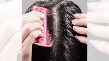 Winter Hair Care Tips: थंडीत केसांमध्ये होणारा कोंडा दूर करण्यासाठी करा हे '5' नैसर्गिक उपाय
