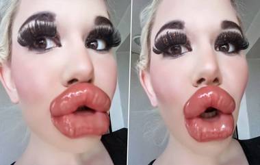 Biggest Lips in World: जगातील सर्वात मोठे ओठ असलेल्या मुलीने पूर्ण केली 20 वी ट्रिटमेंट; इंस्टाग्रामवर शेअर केले फोटो (See Photo)