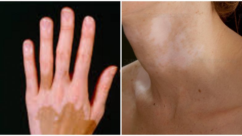 Leucoderma: कोड त्वचारोगावर औषध सापडल्याच दावा