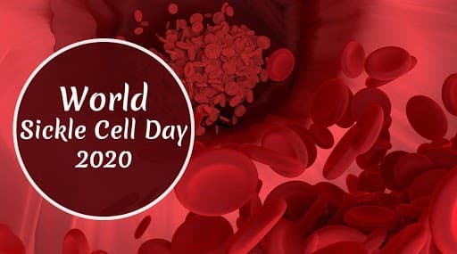 World Sickle Cell Day 2020: 'जागतिक सिकल सेल दिवस' निमित्त जाणून घ्या सिकल सेल आजाराची लक्षणं आणि उपचार