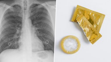 Condom Stuck in Woman's Lung: क्षयरोगाच्या भीतीने महिला डॉक्टरकडे गेली; पण खरे कारण समजताच बसला आश्चर्याचा धक्का 