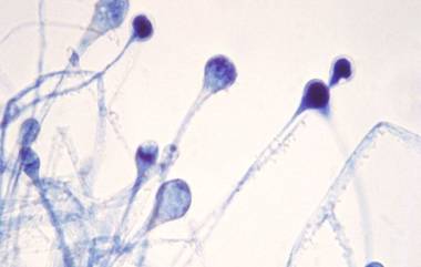 Mucormycosis संसर्गापासून बचावासाठी मधूमेह नियंत्रण आणि दातांची स्वच्छता आवश्यक