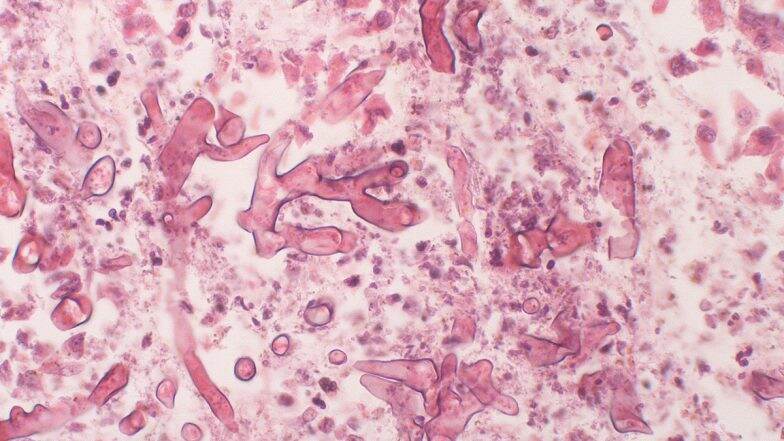 Mucormycosis च्या उपचारासाठी आवश्यक औषधांचा पुरवठा सुनिश्चित करण्यासाठी सरकारने उचलली महत्वाची पावले