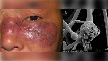 Mucormycosis वरील उपचारांचे दर निश्चित; राज्य सरकारचा महत्त्वपूर्ण निर्णय