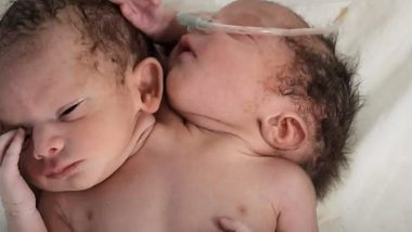 Baby Born With Two Heads: मध्य प्रदेश मध्ये दोन डोकी, तीन हात असलेल्या बाळाचा जन्म
