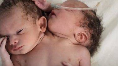 Baby Born With Two Heads: मध्य प्रदेश मध्ये दोन डोकी, तीन हात असलेल्या बाळाचा जन्म