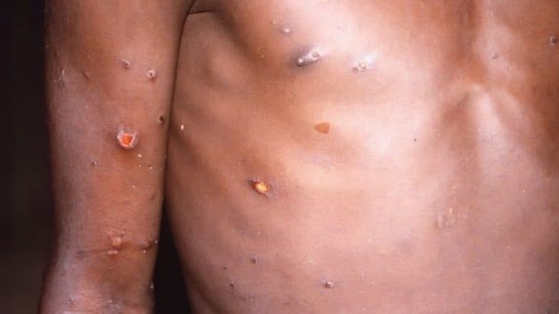 Monkeypox Disease Through Sex: सेक्स केल्याने होऊ शकतो 'मंकीपॉक्स' आजार; गे आणि बायसेक्शुअल लोकांसाठी चेतावणी जारी