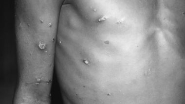 Monkeypox in India: भारतामध्ये झाली मंकीपॉक्सची एन्ट्री? कोलकात्याच्या तरुणामध्ये आढळली संशयास्पद लक्षणे