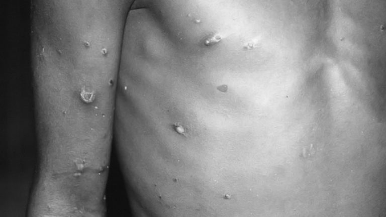 Monkeypox: दिल्लीत एका नायजेरियन व्यक्तीस मंकीपॉक्स विषाणू संसर्ग