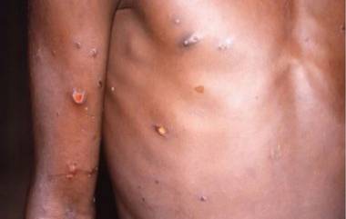 Monkeypox Virus Spread: ब्रिटनमध्ये मंकीपॉक्स विषाणूचा कम्यूनिटी स्प्रेड सुरू; सरकार हाय अलर्टवर