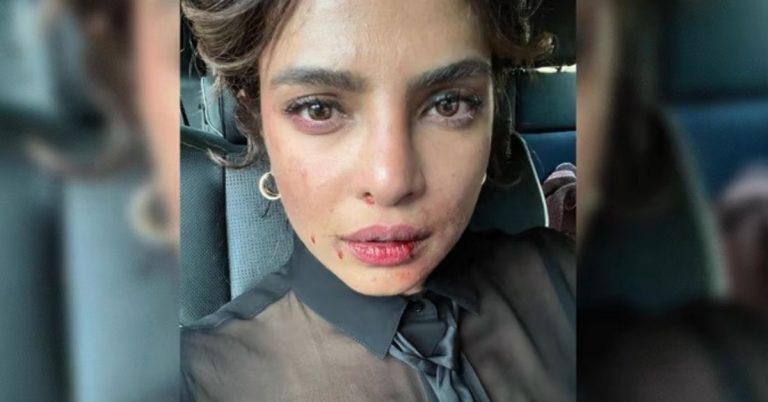 Priyanka Chopra: प्रियंका चोप्राच्या चेहऱ्यावरची जखम पाहून चाहते नाराज, म्हणाले- ठीक आहेस ना?