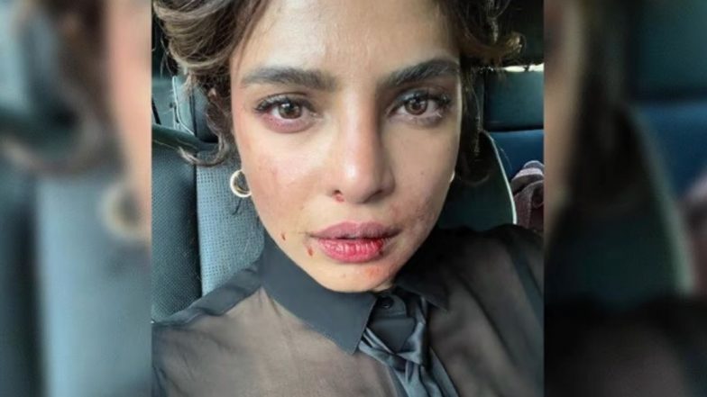 Priyanka Chopra: प्रियंका चोप्राच्या चेहऱ्यावरची जखम पाहून चाहते नाराज, म्हणाले- ठीक आहेस ना?