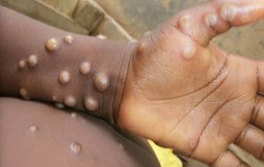 Monkeypox: इंग्लंडमध्ये दोन जणांना मंकीपॉक्सची लागण, जाणून घ्या लक्षणे