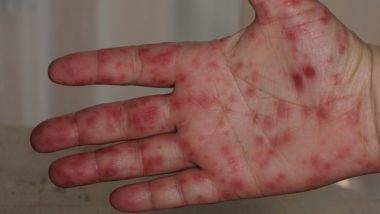 Hand Foot and Mouth Disease: देशात लहान मुलांमध्ये वाढत आहे हात-पाय आणि तोंडाचे आजार; आरोग्य विभाग सतर्क, व्हिडीओमधून जाणून घ्या नक्की काय आहे हा संसर्ग (Watch)