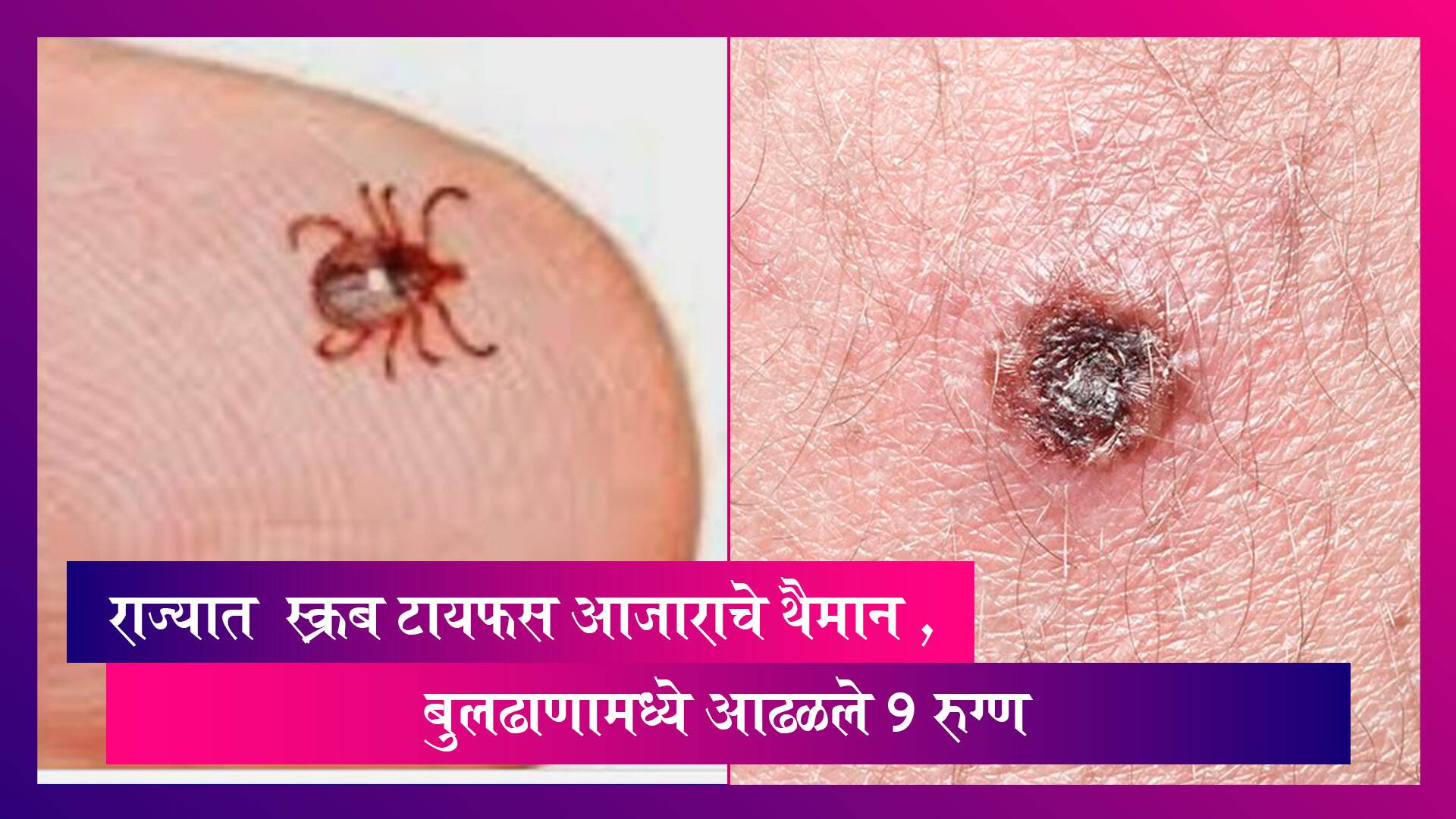 राज्यात 'Scrub Typhus' आजाराचा शिरकाव, बुलढाणामध्ये आढळले 9 रुग्ण