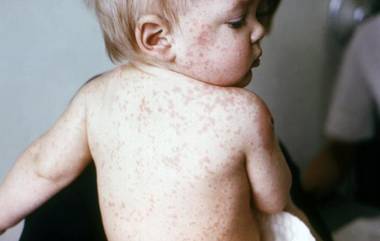 Measles Outbreak in Mumbai: मुंबईत गोवरमुळे एकाचा मृत्यू,रुग्णसंख्या शंभर पार! केंद्रीय आरोग्य मंत्रालयाकडून विशेष सुचना जारी