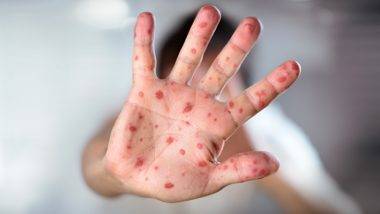 Measles Symptoms and Precautions: गोवरचा धोका वाढतोय! जाणून घ्या या संसर्गजन्य आजाराची लक्षणं आणि सुरक्षित राहण्यासाठी कोणती घ्याल काळजी!