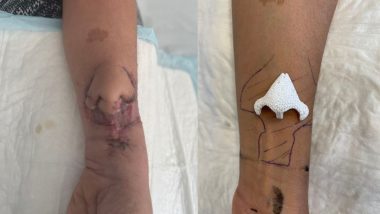 Nose Transplant Surgery: आश्चर्यजनक! फ्रान्समध्ये विचित्र शस्त्रक्रिया; डॉक्टरांनी रुग्णाच्या हातावर वाढवलेल्या नाकाचं केलं चेहऱ्यावर प्रत्यारोपण