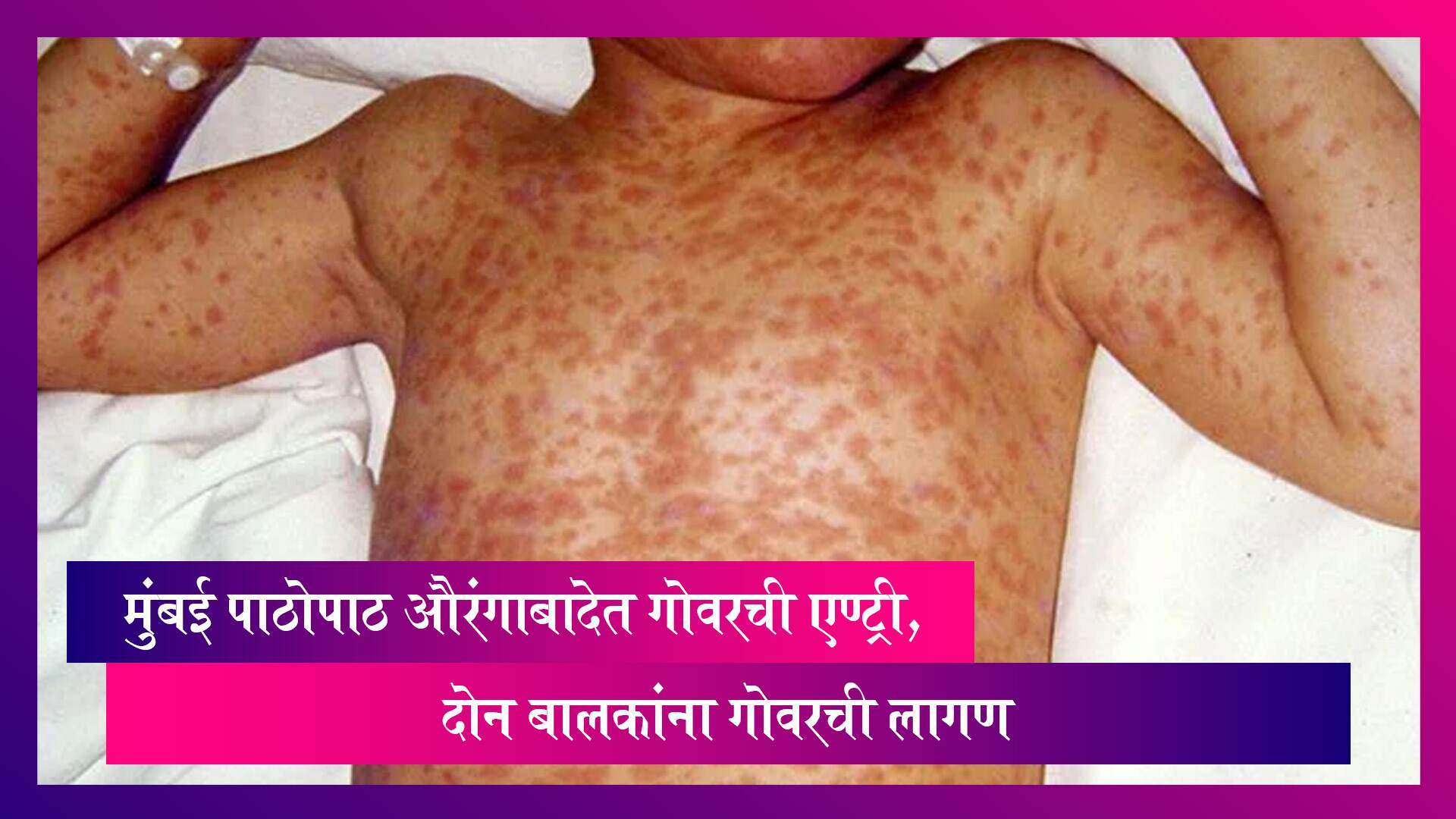Aurangabad Measles: मुंबई पाठोपाठ औरंगाबादेत गोवरची एण्ट्री, दोन बालकांना गोवरची लागण