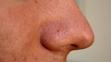 Skin Cancer: ती म्हणाली, 'नाकावरच्या पिंपल्सला औषध द्या'; डॉक्टरांनी सांगितलं 'कॅन्सर आहे तुम्ही ट्रीटमेंट घ्या'