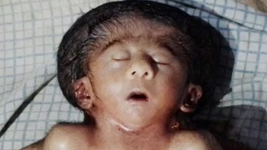 Viral: बिहारच्या छपरा शहरात जन्माला आली 4 हात, 4 पाय आणि 2 ह्रदय असलेले बाळ, पाहा फोटो
