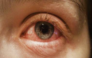 Eye Infection in Dhule: आळंदीनंतर आता धुळ्यात 'डोळे येण्या'ची समस्या; वेगाने पसरतोय संसर्ग, जाणून घ्या लक्षणे व कशी घ्याल काळजी