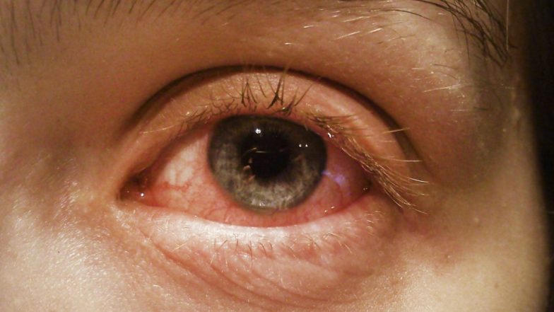 Conjunctivitis in Pune: देवाची आळंदीमध्ये अवघ्या तीन दिवसात 1,600 मुलांना उद्भवली 'डोळे येण्याची' समस्या; शाळांना सुट्टी जाहीर करण्याचे आवाहन