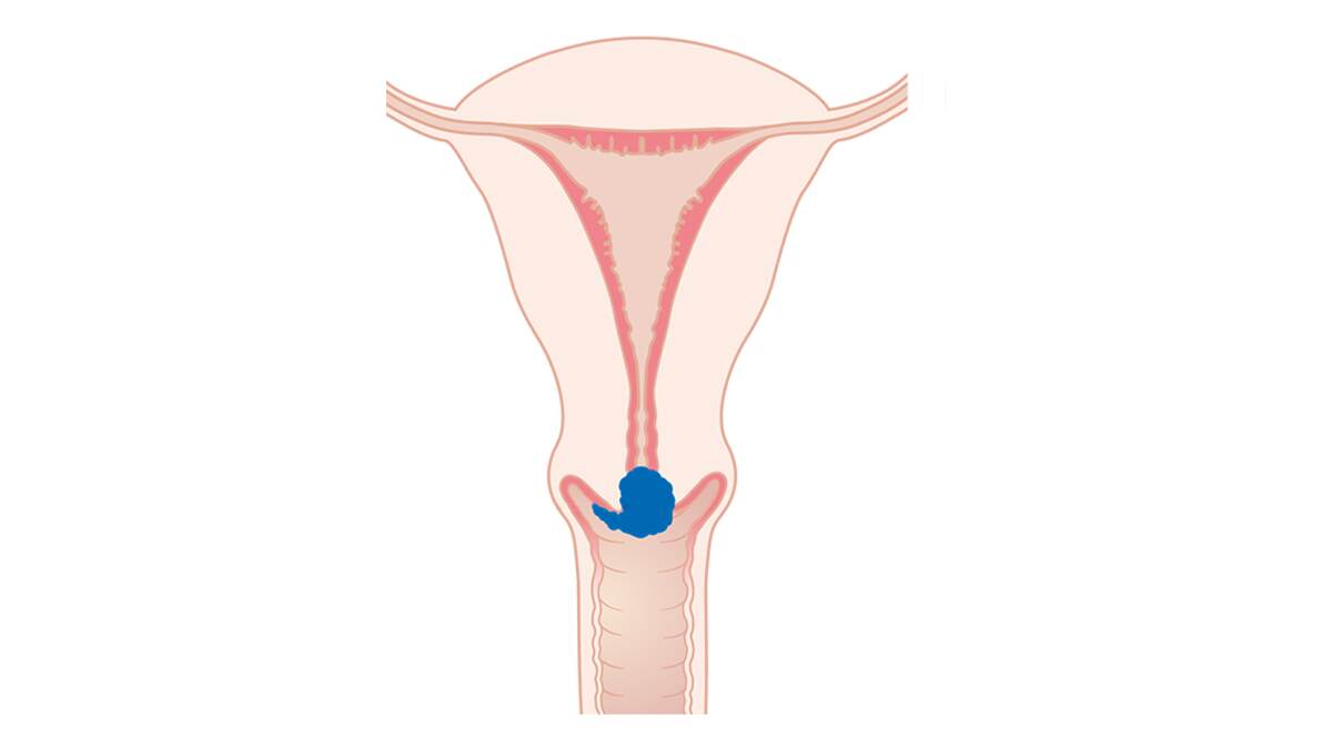 Cervical Cancer: गर्भाशयाच्या मुखाच्या कर्करोगामुळे भारतात दरवर्षी होतो 77 हजार महिलांचा मृत्यू, जाणून घ्या लक्षणे आणि कारणे