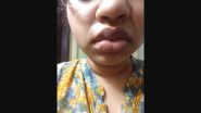 Dentist Chopped Off Woman’s Lip: हैदराबादमधील डेंटिस्टने कापला महिलेचे ओठ; म्हणाला, 'आता तू छान दिसतेस'