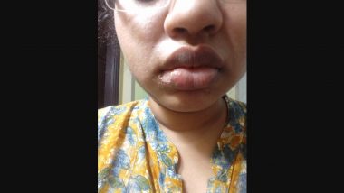 Dentist Chopped Off Woman’s Lip: हैदराबादमधील डेंटिस्टने कापला महिलेचे ओठ; म्हणाला, 'आता तू छान दिसतेस'