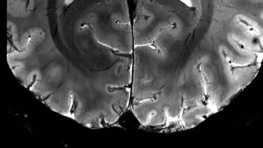 World's Most Powerful MRI Scanner: जगातील सर्वात शक्तिशाली एमआरआय स्कॅन मशीनमधून घेतला मानवी मेंदूचा पहिला स्पष्ट फोटो; अवघ्या 4 मिनिटांत पार पडली संपूर्ण प्रक्रिया